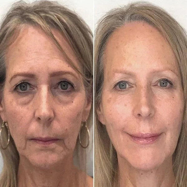 Anti-Ageing Botox Effect Serum