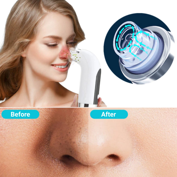 Blackhead Vacuum Facial - Skincare - HealthCare™